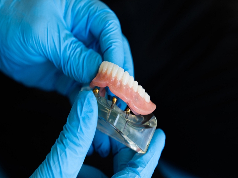 5 TIPS para cuidar tu prótesis dental