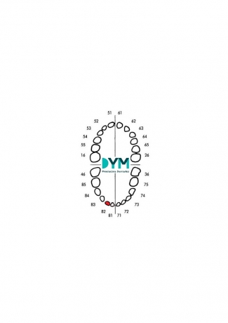 DIENTE Nº82 INCISIVO LATERAL INF.DER 1U