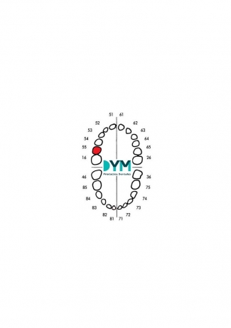 55 SECOND MOLAR UPPER TEETH RIGHT PART 1U