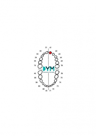 61 CENTRAL INCISOR UPPER TEETH LEFT PART 1U