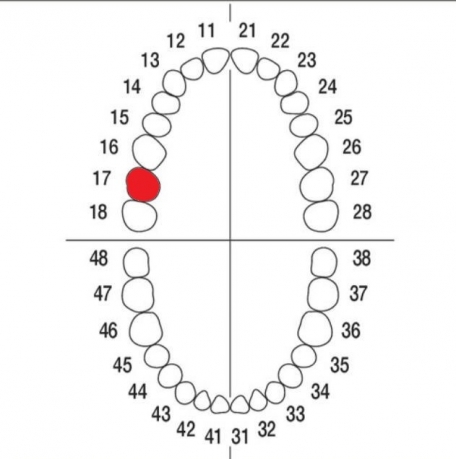 DIENTE Nº17 MODELO A3