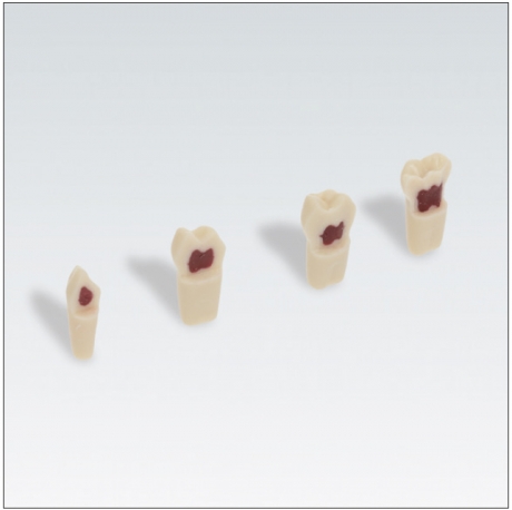 DIENTE 5.5 ZPUW ENDO FRASACO